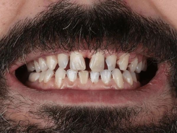 Before crowns and bridges treatment